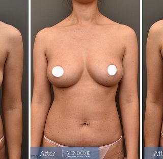 療程效果因人而異，上圖為D罩杯卻乳房下垂的女性在做完自體脂肪隆乳之後​手術後一個月、手術後八個月成效